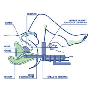 Curiethérapie permanente (LDR)